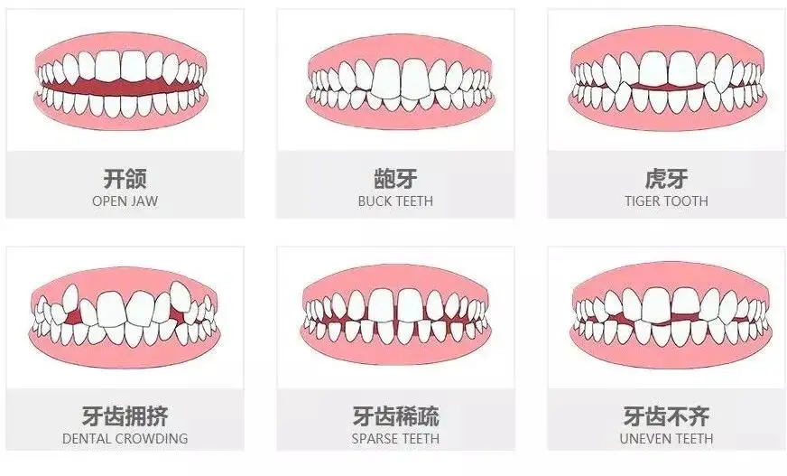 什么情况下的牙齿建议矫正呢？